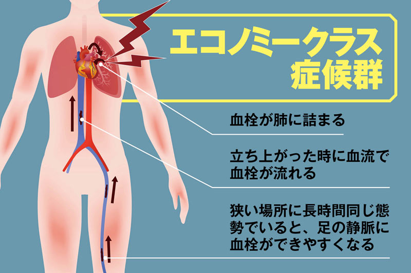 熊本地震 犠牲者の5分の4が災害関連死 エコノミークラス症候群どう防ぐ ウェザーニュース