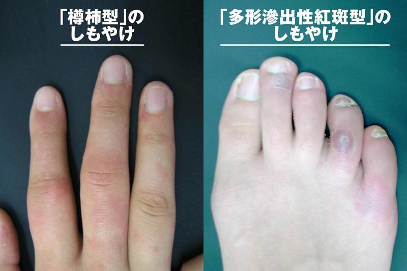 腫れる が 足 親指 の