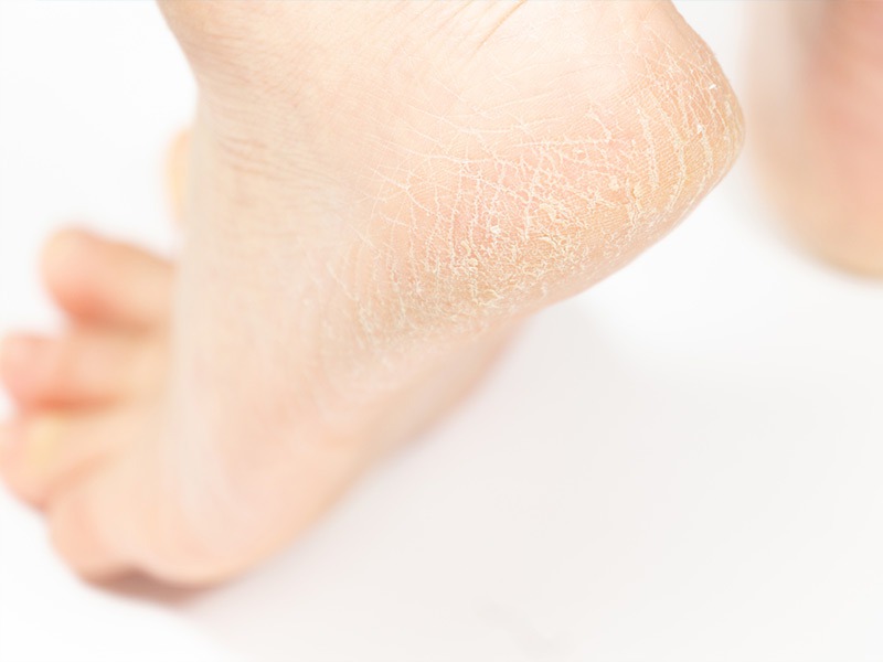 みんな知りたい ガサガサかかと への効果的なケア ウェザーニュース みんな知りたい ガサガサかかと への効果的なケア ウェザーニュース