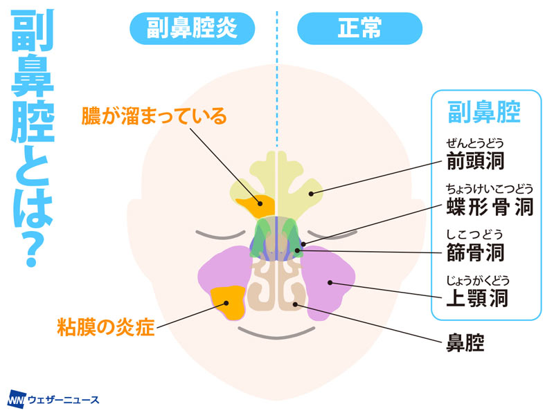 副鼻腔炎 黄色いネバネバ鼻水は危険サイン？ - ウェザーニュース